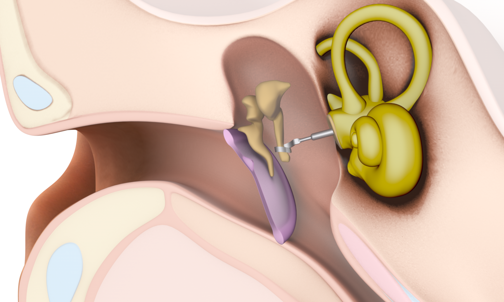 Passive Mittelohrimplantate